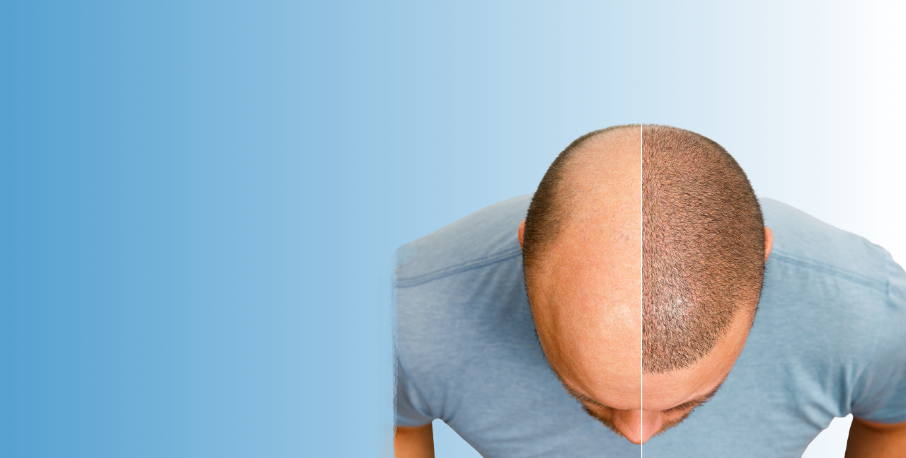 Hair Transplantation